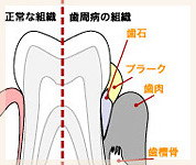 歯周病について