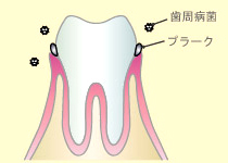 初期段階（歯肉炎）
