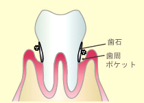 第1段階（歯周炎第1～2度）