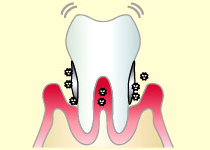 第2段階（歯周炎第3～4度）
